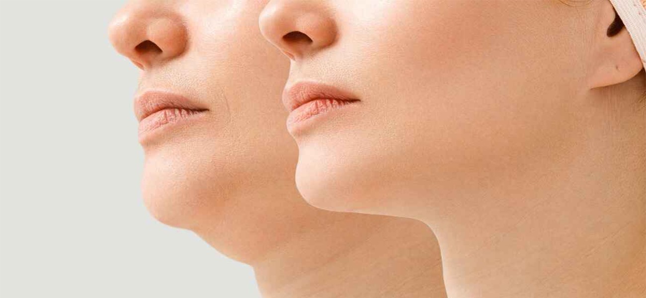 درد بعد از ساکشن غبغب