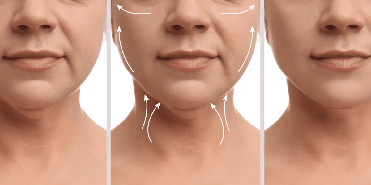 افتادگی پوست بعد از ساکشن غبغب