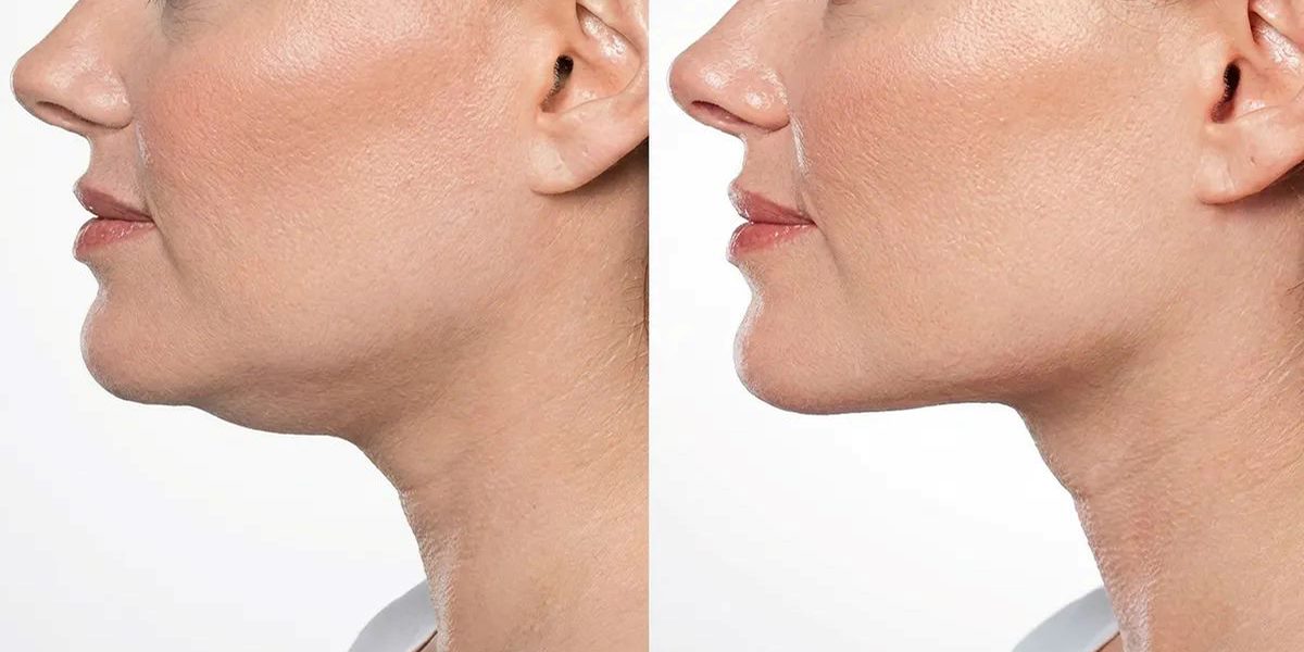 رفع غبغب بدون جراحی